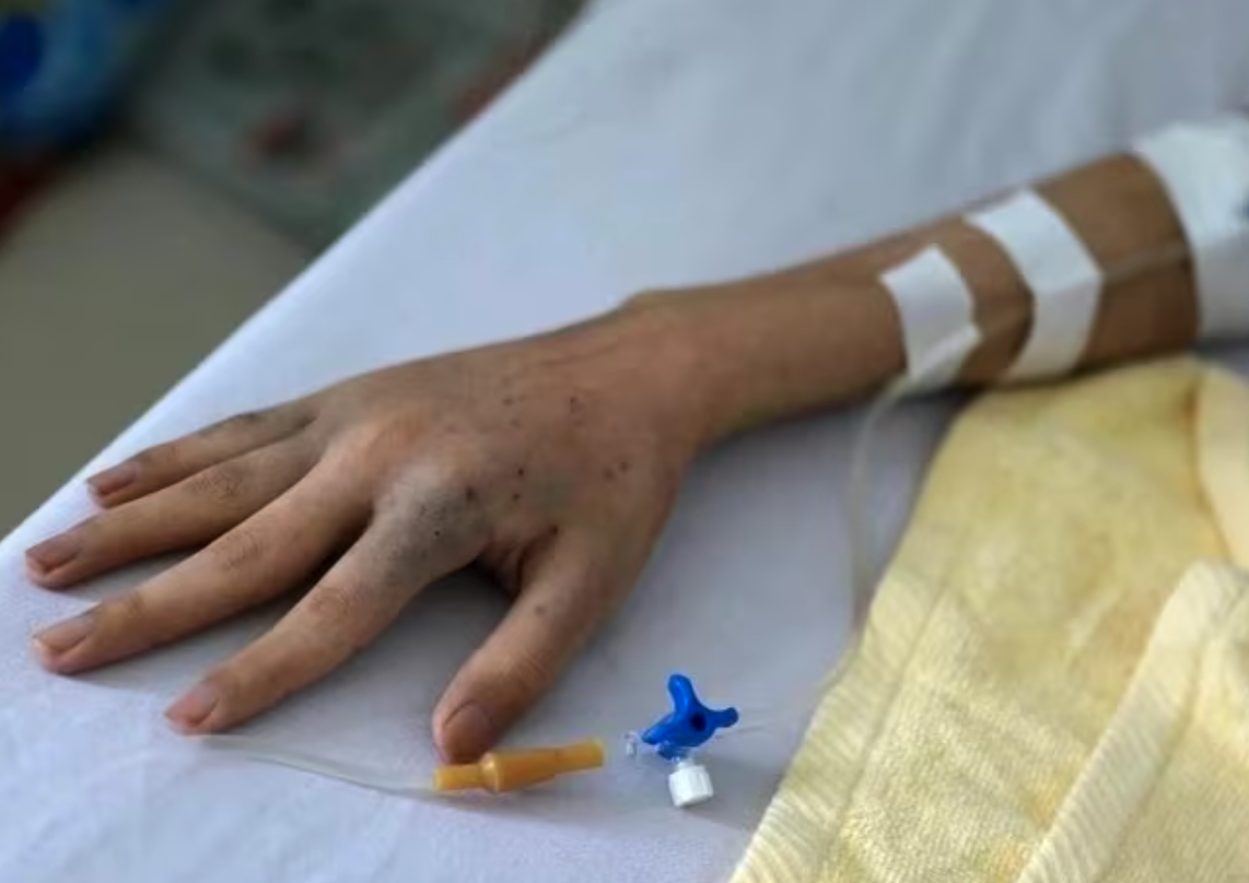 CAR T cell therapy in Vietnam 2